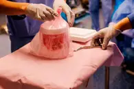 Свиная почка впервые помогла мужчине прожить девять месяцев без диализа