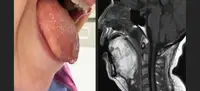 Болезнь накопления у португалки проявилась одышкой и увеличением языка
