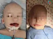 Три часа ювелирной работы: В Башкирии врачи восстановили губу восьмимесячному малышу