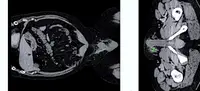 Некротизирующее воспаление яичка и его придатка оказалось проявлением болезни Крона