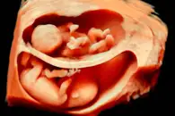 Ученые описали редкий клинический случай внутриутробного распространения рака между близнецами
